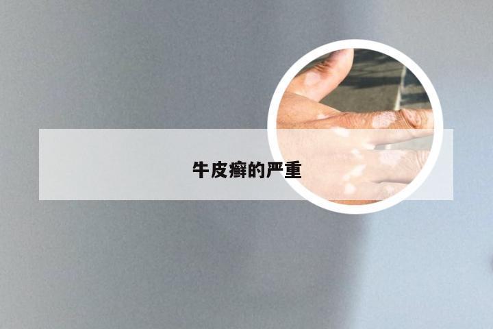 牛皮癣的严重