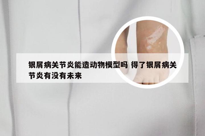 银屑病关节炎能造动物模型吗 得了银屑病关节炎有没有未来