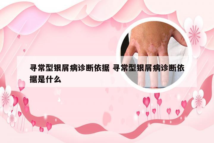 寻常型银屑病诊断依据 寻常型银屑病诊断依据是什么