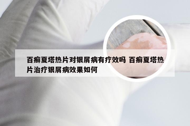 百癣夏塔热片对银屑病有疗效吗 百癣夏塔热片治疗银屑病效果如何