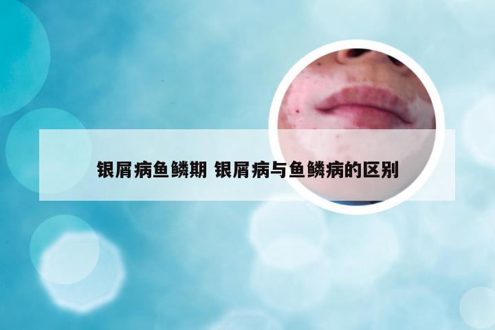 银屑病鱼鳞期 银屑病与鱼鳞病的区别