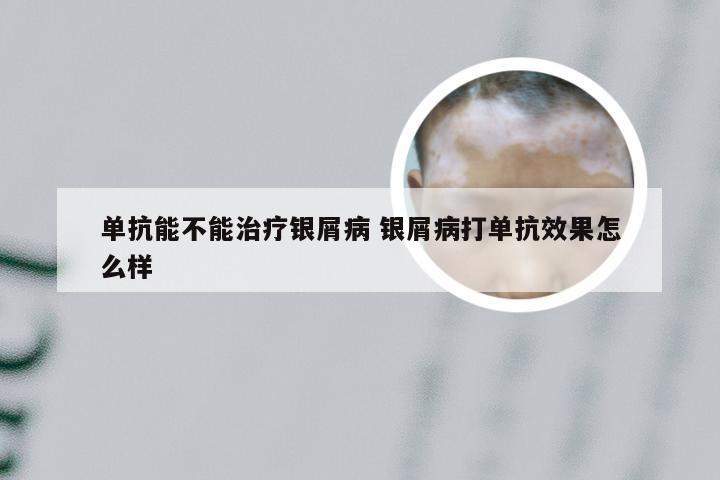 单抗能不能治疗银屑病 银屑病打单抗效果怎么样