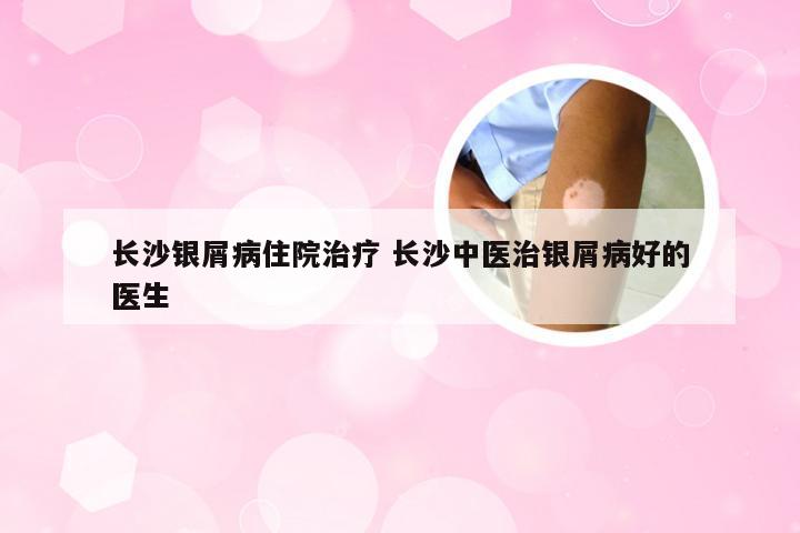长沙银屑病住院治疗 长沙中医治银屑病好的医生