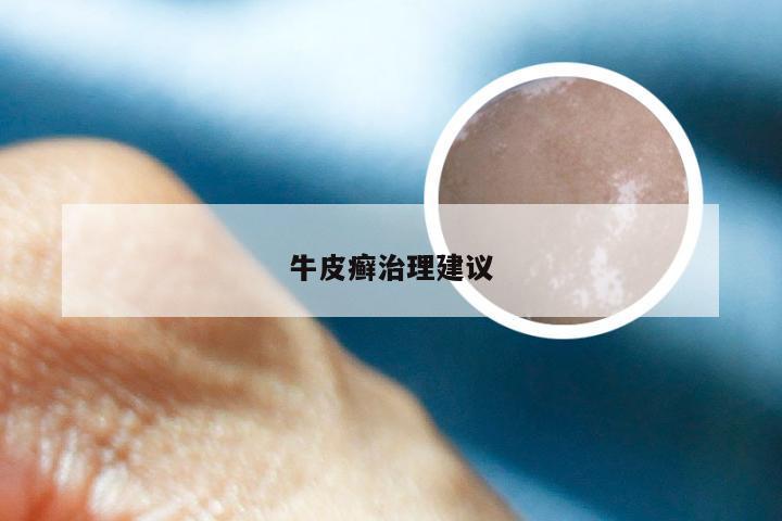 牛皮癣治理建议