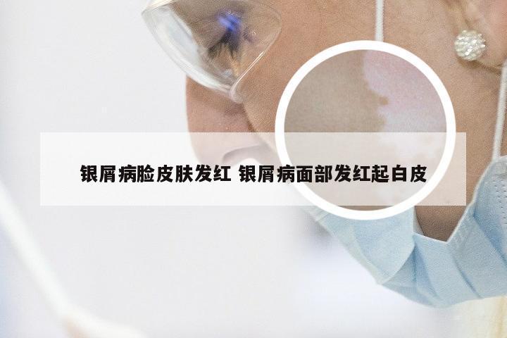 银屑病脸皮肤发红 银屑病面部发红起白皮