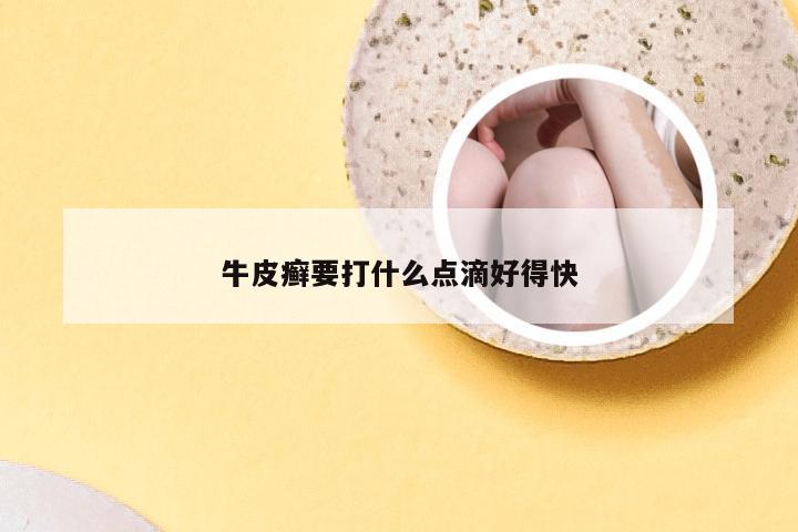 牛皮癣要打什么点滴好得快