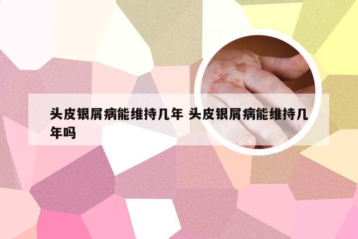 头皮银屑病能维持几年 头皮银屑病能维持几年吗