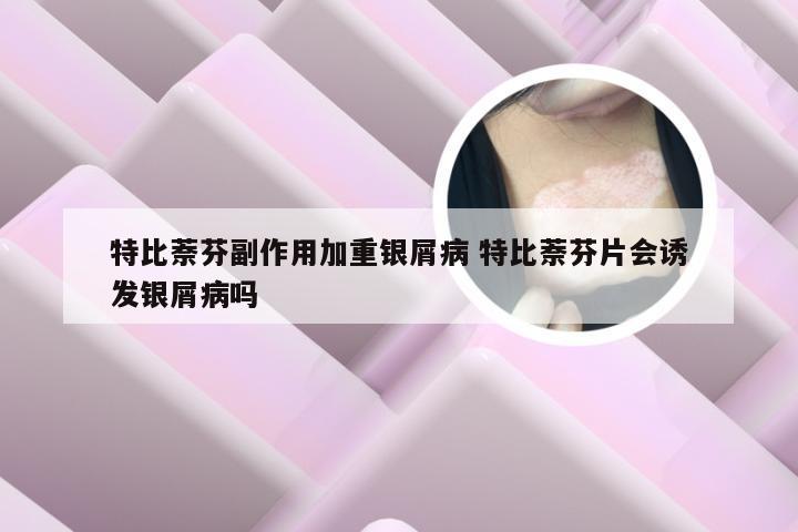 特比萘芬副作用加重银屑病 特比萘芬片会诱发银屑病吗