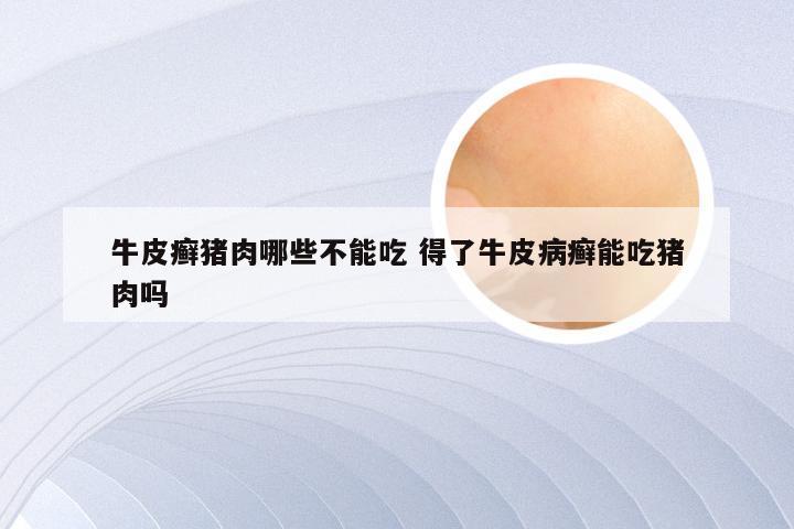 牛皮癣猪肉哪些不能吃 得了牛皮病癣能吃猪肉吗