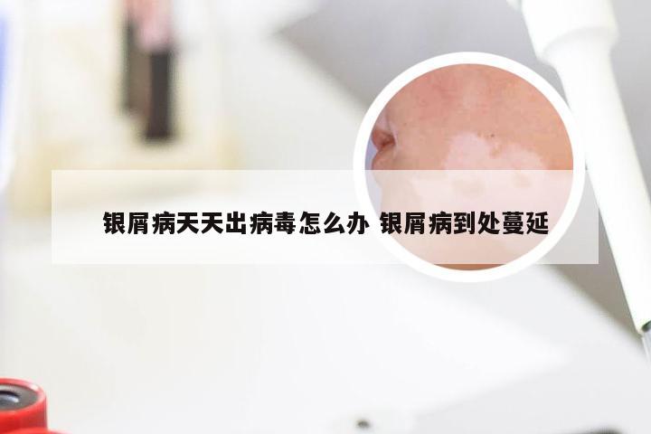 银屑病天天出病毒怎么办 银屑病到处蔓延