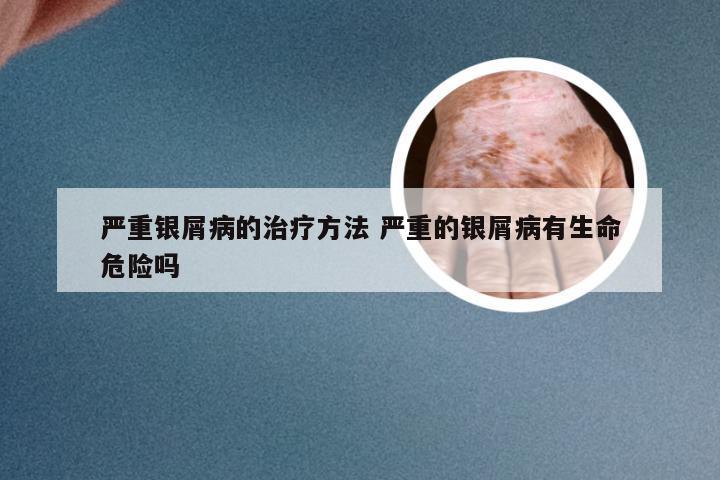 严重银屑病的治疗方法 严重的银屑病有生命危险吗