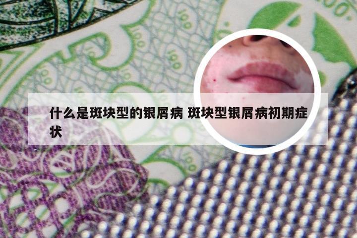 什么是斑块型的银屑病 斑块型银屑病初期症状