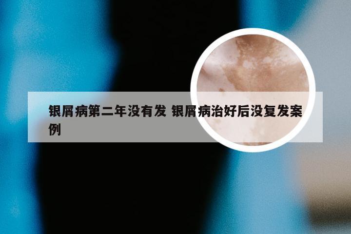 银屑病第二年没有发 银屑病治好后没复发案例