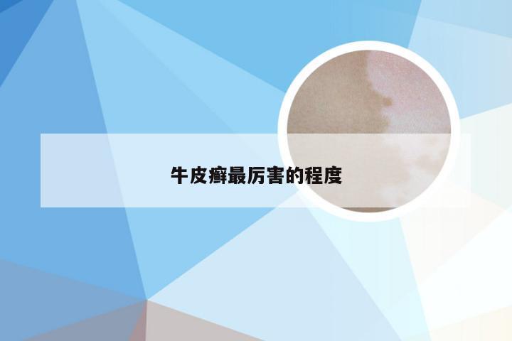 牛皮癣最厉害的程度