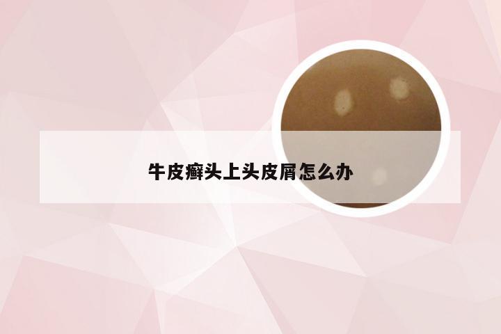 牛皮癣头上头皮屑怎么办