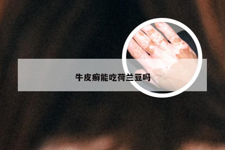 牛皮癣能吃荷兰豆吗