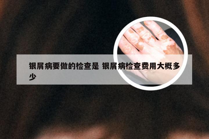 银屑病要做的检查是 银屑病检查费用大概多少