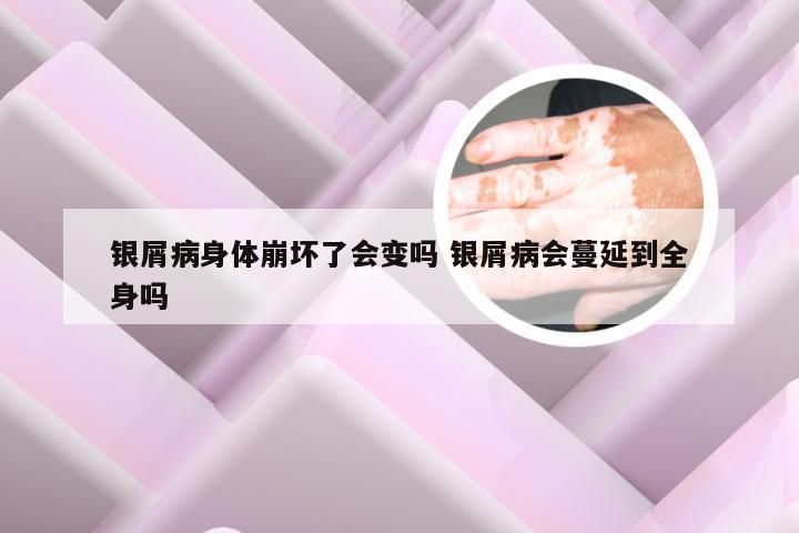 银屑病身体崩坏了会变吗 银屑病会蔓延到全身吗