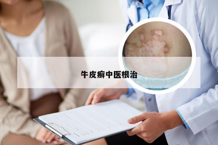牛皮癣中医根治