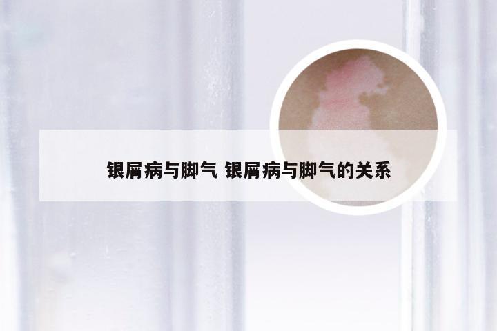 银屑病与脚气 银屑病与脚气的关系