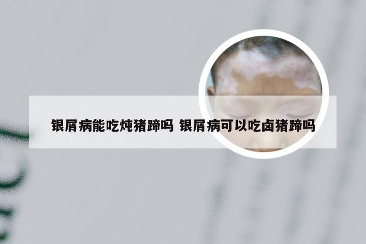 银屑病能吃炖猪蹄吗 银屑病可以吃卤猪蹄吗