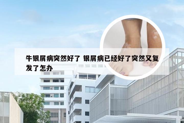 牛银屑病突然好了 银屑病已经好了突然又复发了怎办