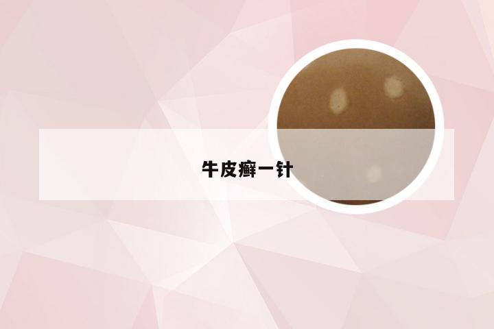 牛皮癣一针