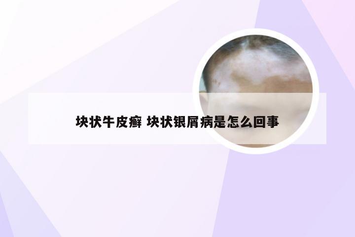 块状牛皮癣 块状银屑病是怎么回事