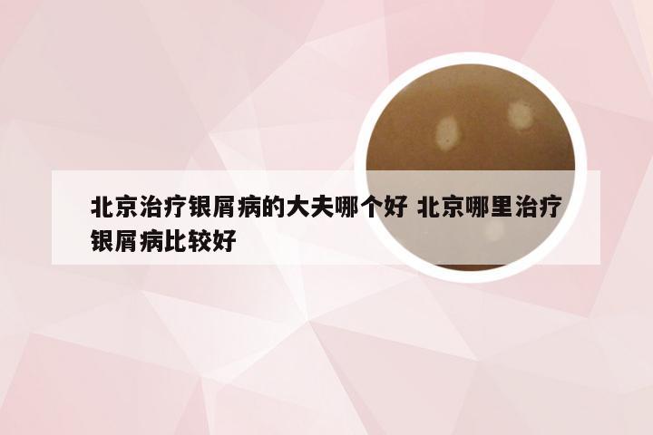 北京治疗银屑病的大夫哪个好 北京哪里治疗银屑病比较好
