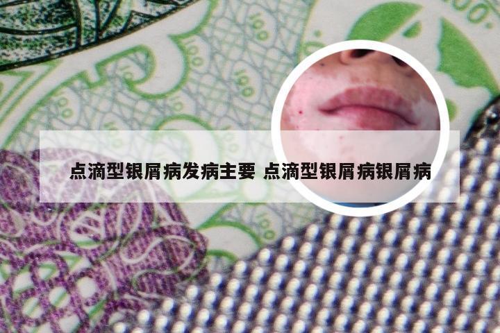 点滴型银屑病发病主要 点滴型银屑病银屑病