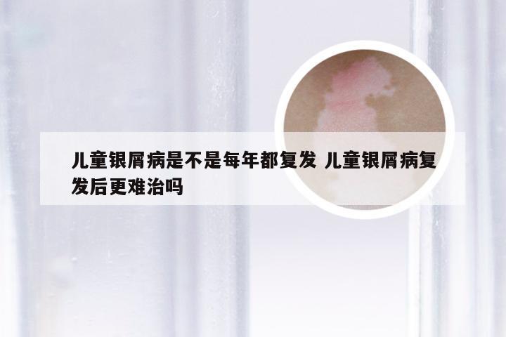 儿童银屑病是不是每年都复发 儿童银屑病复发后更难治吗