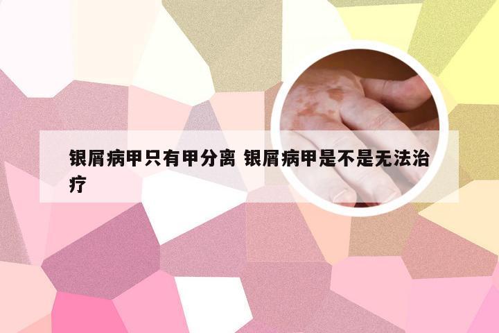 银屑病甲只有甲分离 银屑病甲是不是无法治疗