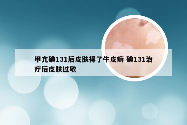 甲亢碘131后皮肤得了牛皮癣 碘131治疗后皮肤过敏