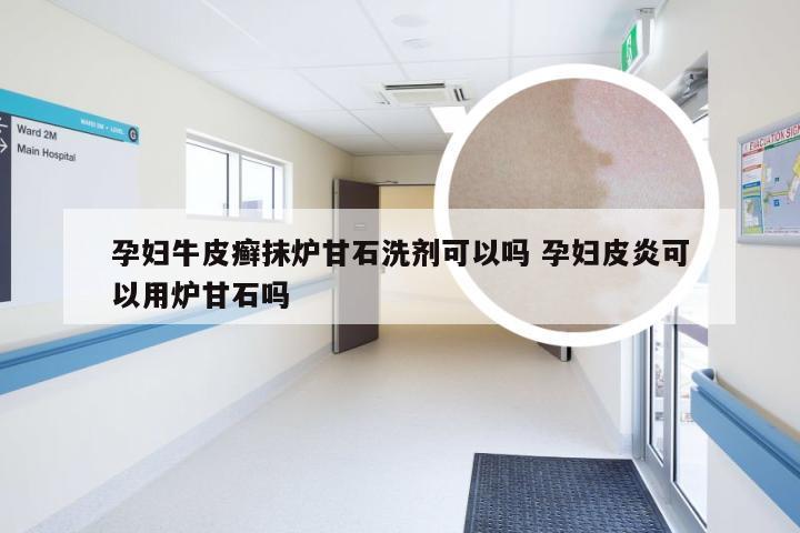 孕妇牛皮癣抹炉甘石洗剂可以吗 孕妇皮炎可以用炉甘石吗