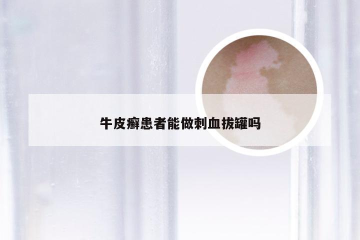 牛皮癣患者能做刺血拔罐吗