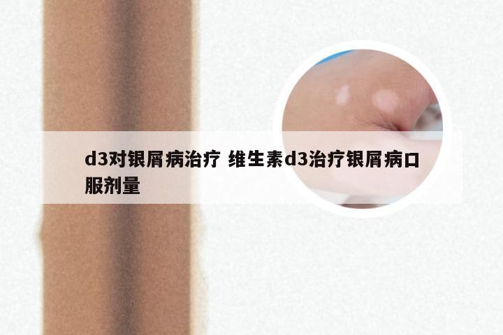 d3对银屑病治疗 维生素d3治疗银屑病口服剂量