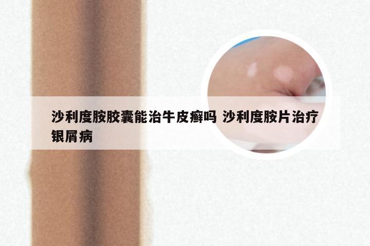 沙利度胺胶囊能治牛皮癣吗 沙利度胺片治疗银屑病