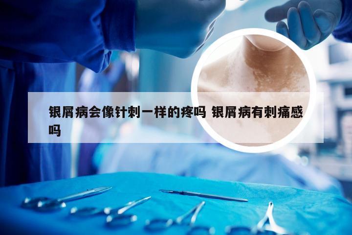银屑病会像针刺一样的疼吗 银屑病有刺痛感吗