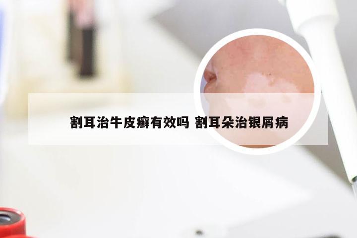 割耳治牛皮癣有效吗 割耳朵治银屑病