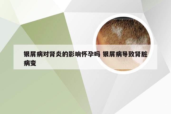 银屑病对肾炎的影响怀孕吗 银屑病导致肾脏病变