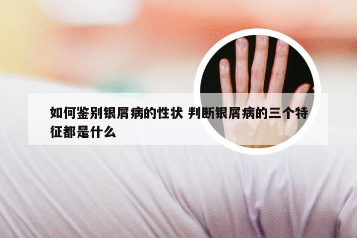 如何鉴别银屑病的性状 判断银屑病的三个特征都是什么