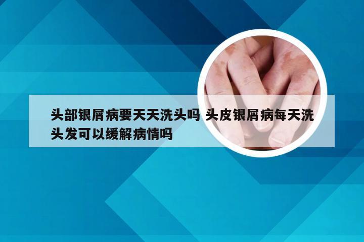 头部银屑病要天天洗头吗 头皮银屑病每天洗头发可以缓解病情吗
