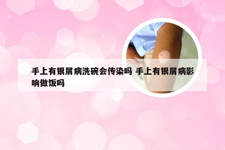 手上有银屑病洗碗会传染吗 手上有银屑病影响做饭吗
