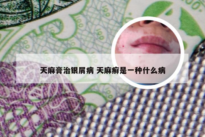 天麻膏治银屑病 天麻癣是一种什么病