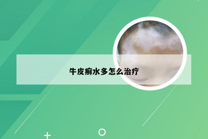 牛皮癣水多怎么治疗