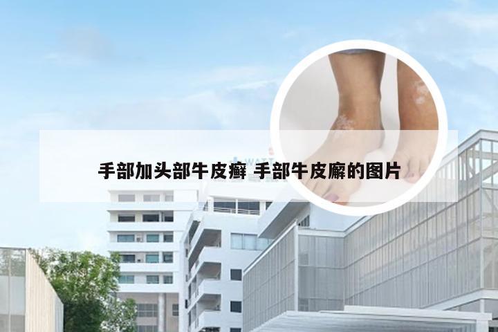 手部加头部牛皮癣 手部牛皮廨的图片