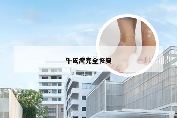 牛皮癣完全恢复
