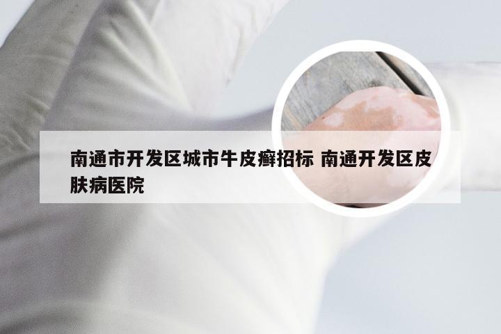 南通市开发区城市牛皮癣招标 南通开发区皮肤病医院