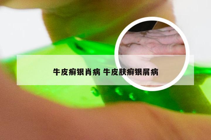 牛皮癣银肖病 牛皮肤癣银屑病