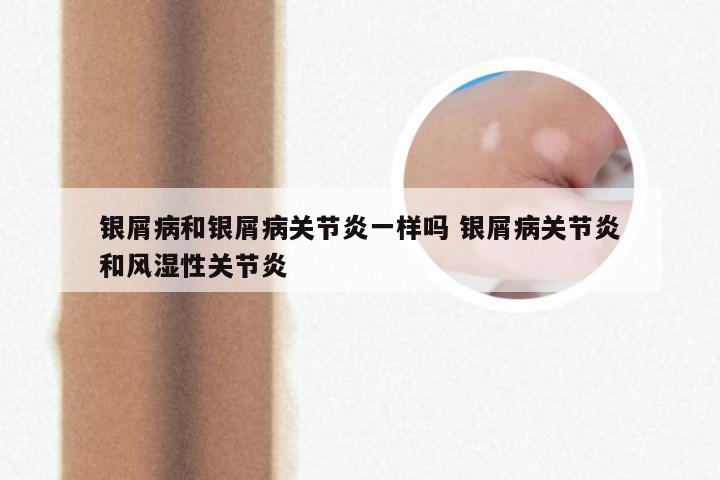 银屑病和银屑病关节炎一样吗 银屑病关节炎和风湿性关节炎